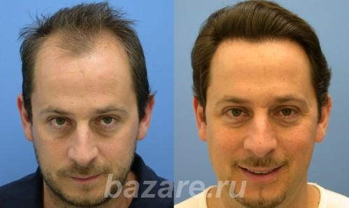 Средство для роста волос из Германии, Тольятти